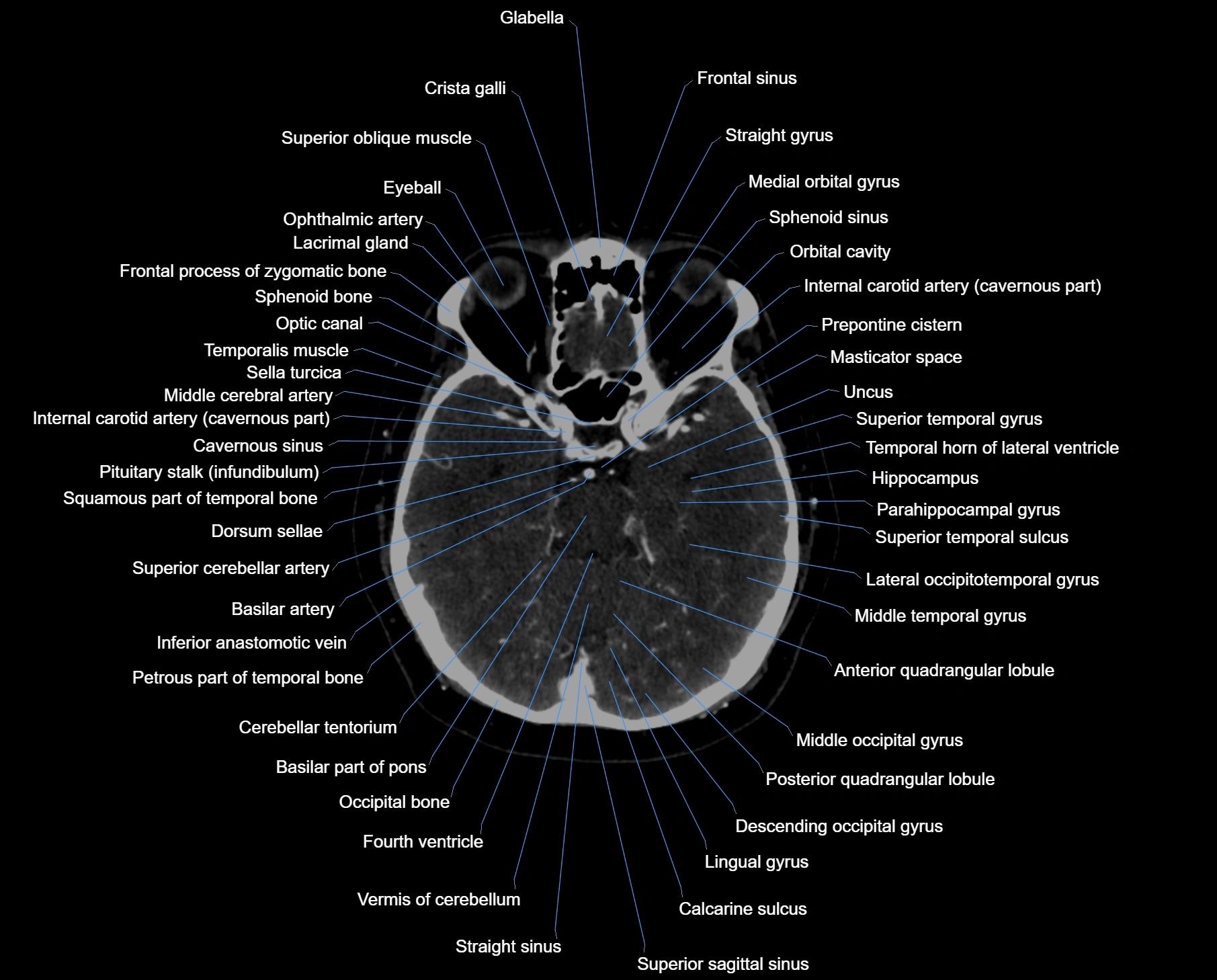 CT scan brain axial labelled cross sectional anatomy image-img-000025.webp